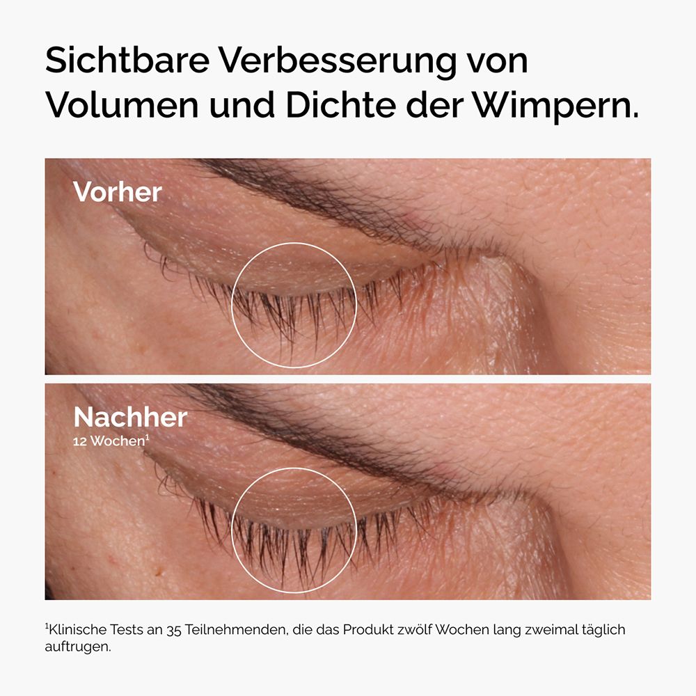 Vergleich von Wimpern vor und nach 12 Wochen. Deutliche Verbesserung der Dichte.