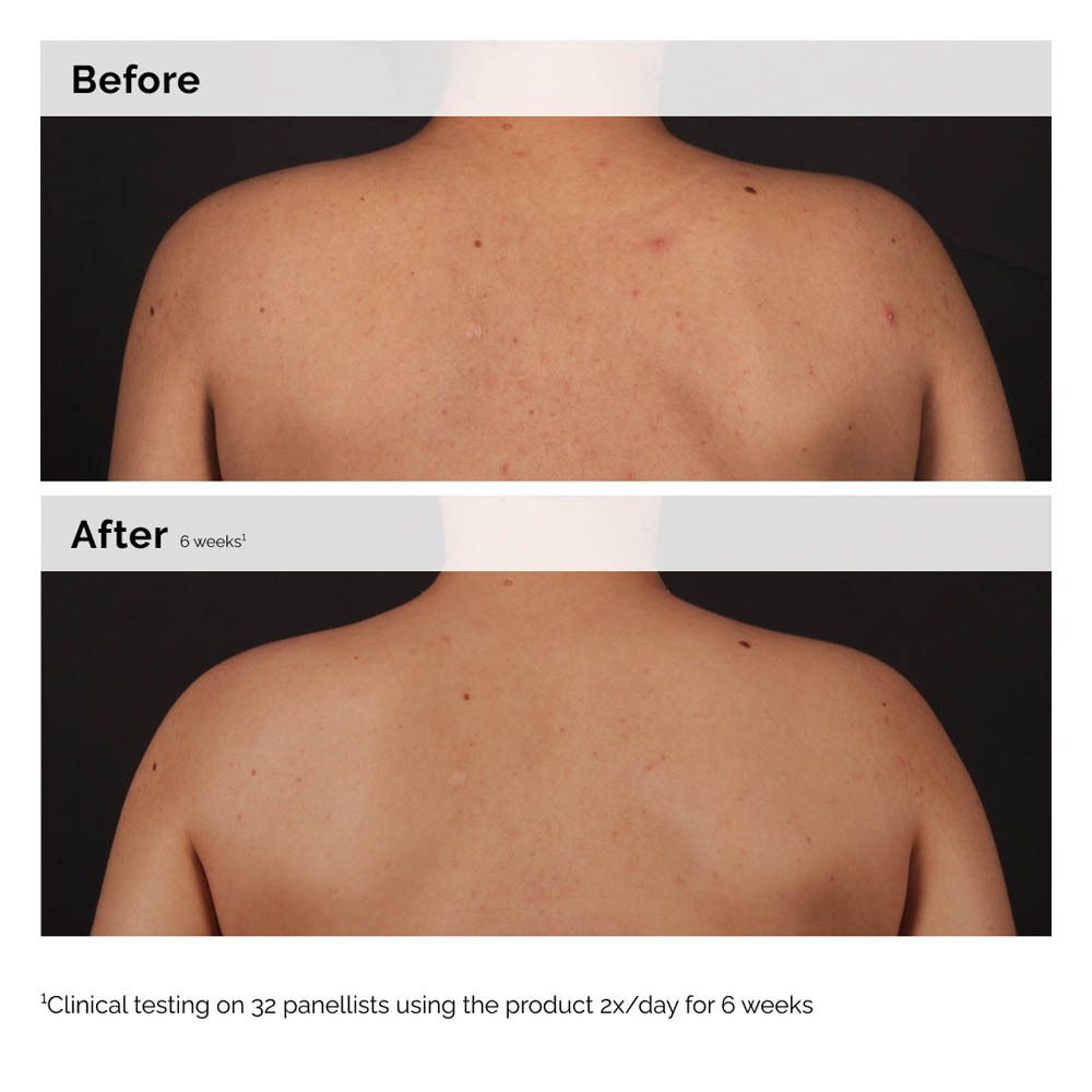 Zwei Bilder nebeneinander: Rücken vor und nach Anwendung. Text: Clinical testing on 32 panellists using the product 2x/day for 6 weeks.
