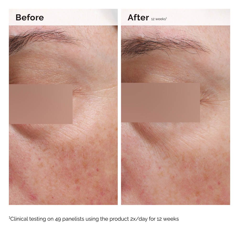Vorher-Nachher-Vergleich von Haut. Text: Clinical testing on 49 panelists using the product 2x/day for 12 weeks.