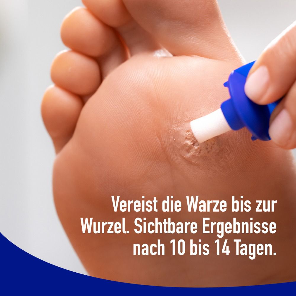 Fuß mit Warze. Anwendung mit Applikator. Sichtbare Ergebnisse nach 10-14 Tagen. Vereist die Warze.
