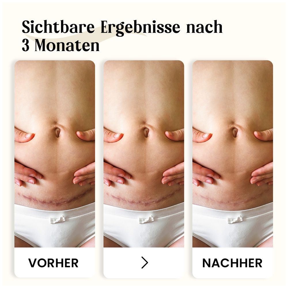 Drei Bilder zeigen Ergebnisse nach 3 Monaten. Vorher-Nachher-Vergleich von Narben am Bauch.