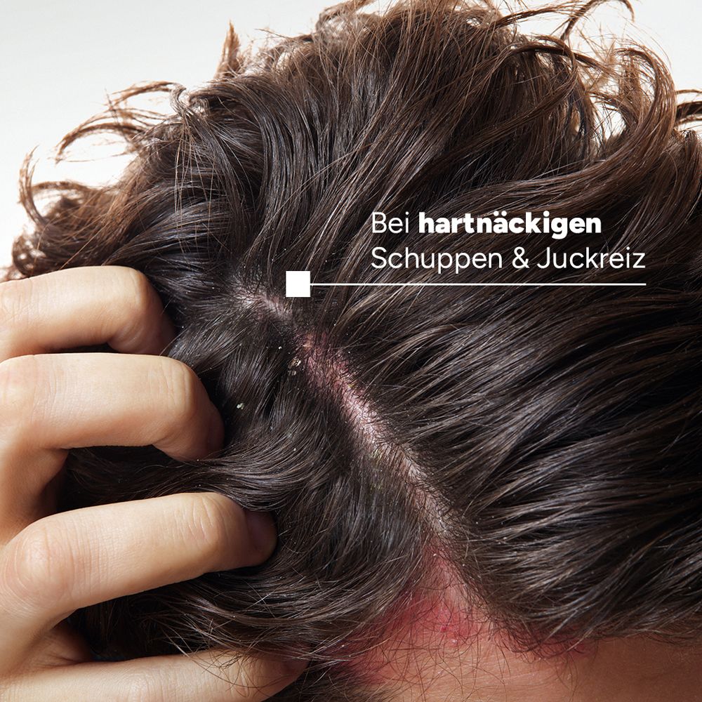 Nahaufnahme einer Kopfhaut mit Schuppen und Juckreiz. Text: Bei hartnäckigen Schuppen & Juckreiz.