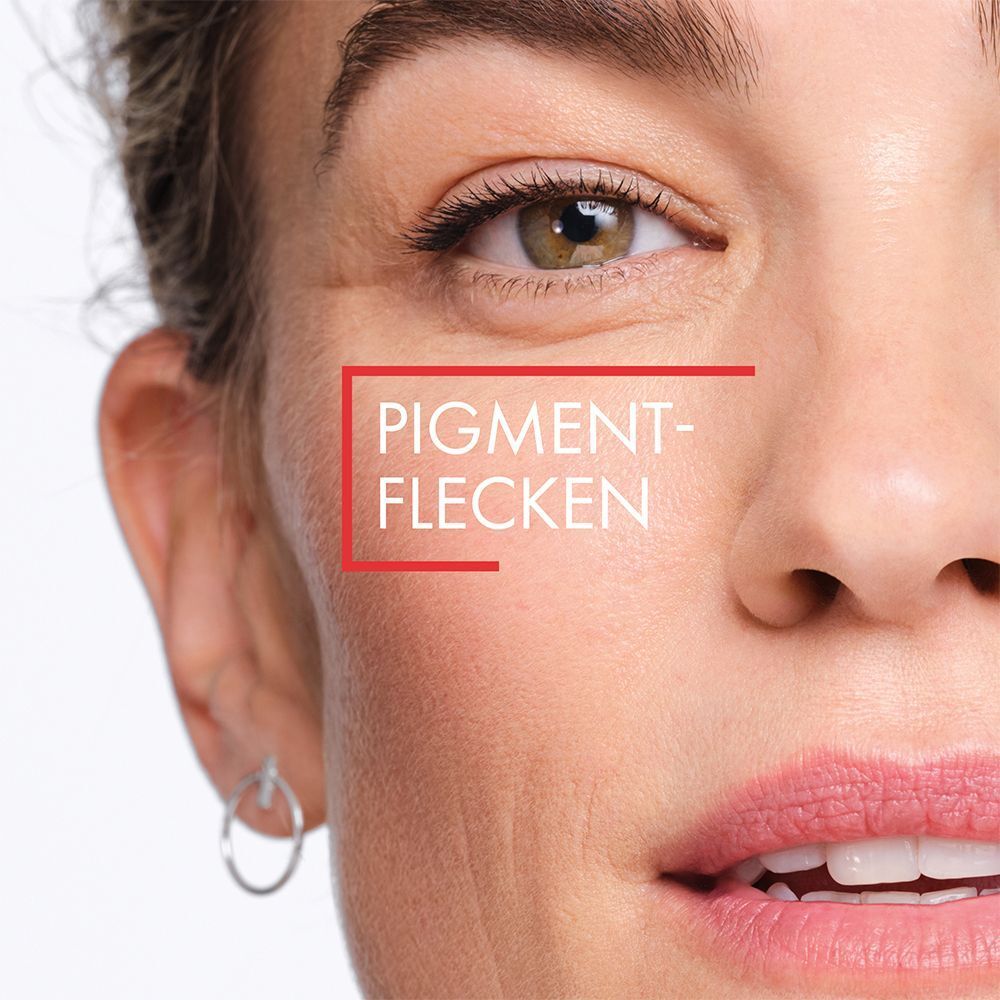 Nahaufnahme eines Gesichts. Text: Pigmentflecken.