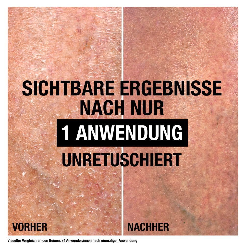 Vorher-Nachher-Vergleich von Haut. Text: Sichtbare Ergebnisse nach nur 1 Anwendung. Unretuschiert. Vergleich an den Beinen, 34 Anwenderinnen nach einmaliger Anwendung.