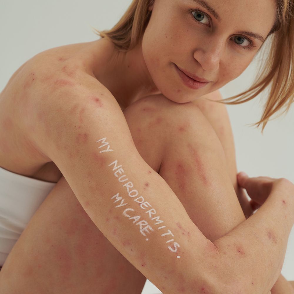 Frau mit Hautrötungen am Arm, auf dem 'MY NEURODERMITIS. MY CARE.' geschrieben steht.