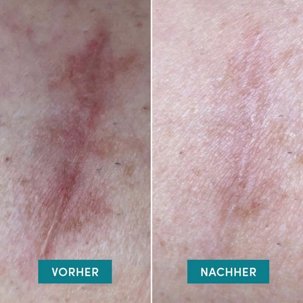 Zwei Hautpartien nebeneinander. Links: Narbe vor der Behandlung. Rechts: Narbe nach der Behandlung. Text: Vorher, Nachher.