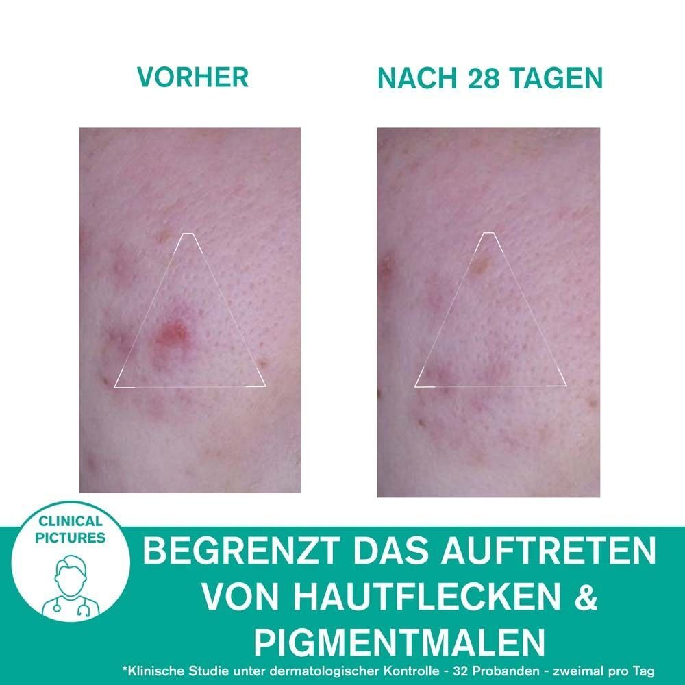 Vorher-Nachher-Vergleich von Hautunreinheiten. Text: Begrenzt das Auftreten von Hautflecken & Pigmentmalen. Klinische Bilder.