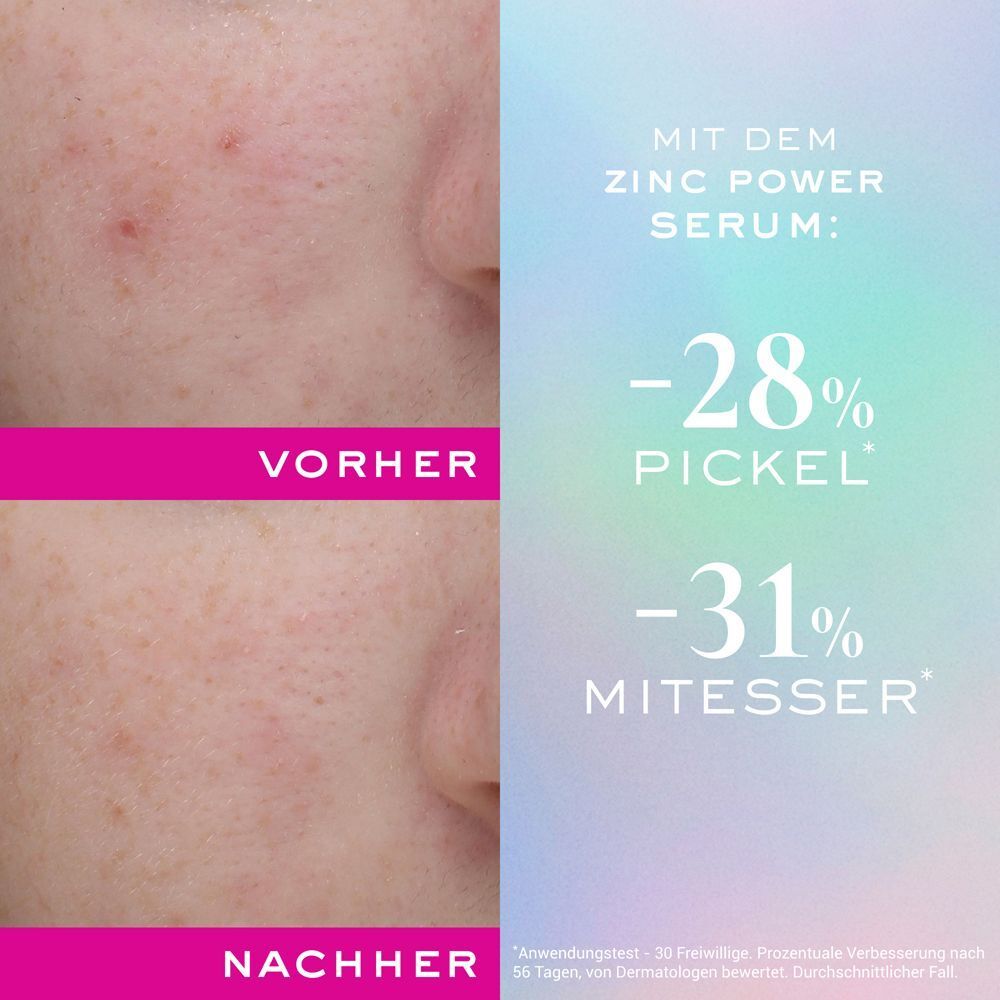 Vergleichsbild: Gesichtshaut vor und nach der Anwendung des Zinc Power Serums. Ergebnisse: -28% Pickel, -31% Mitesser.