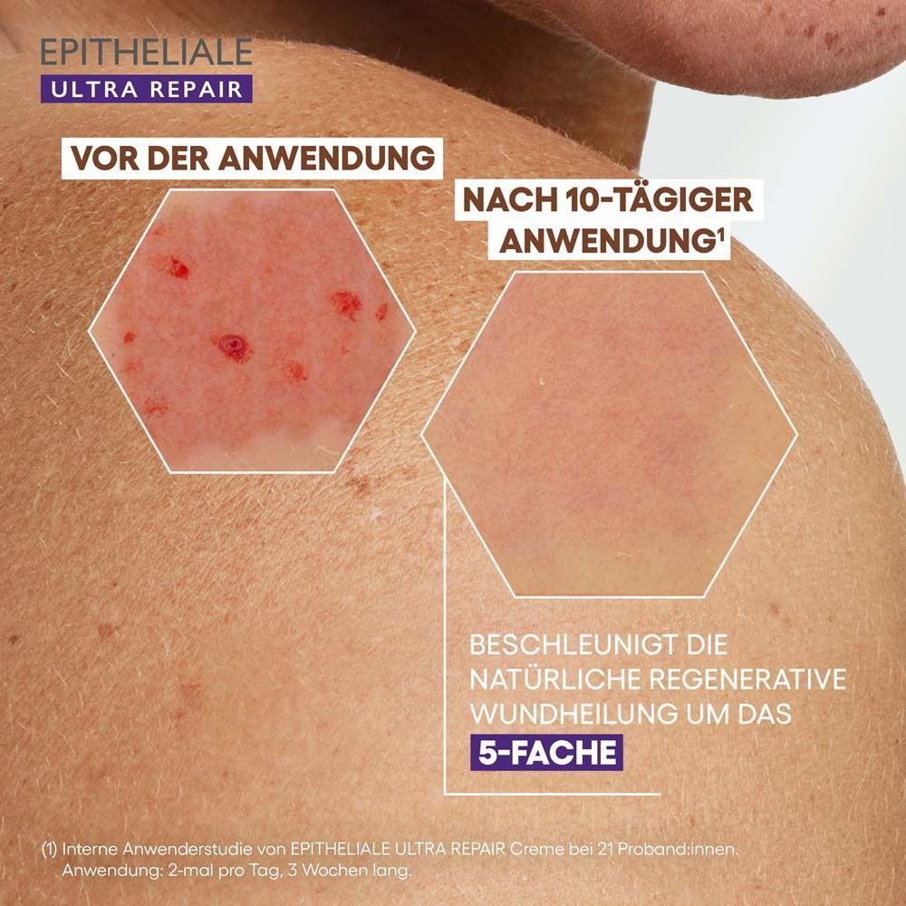 Haut vor und nach 10-tägiger Anwendung. Text: EPITHELIALE ULTRA REPAIR. Text: Beschleunigt die natürliche regenerative Wundheilung um das 5-fache.
