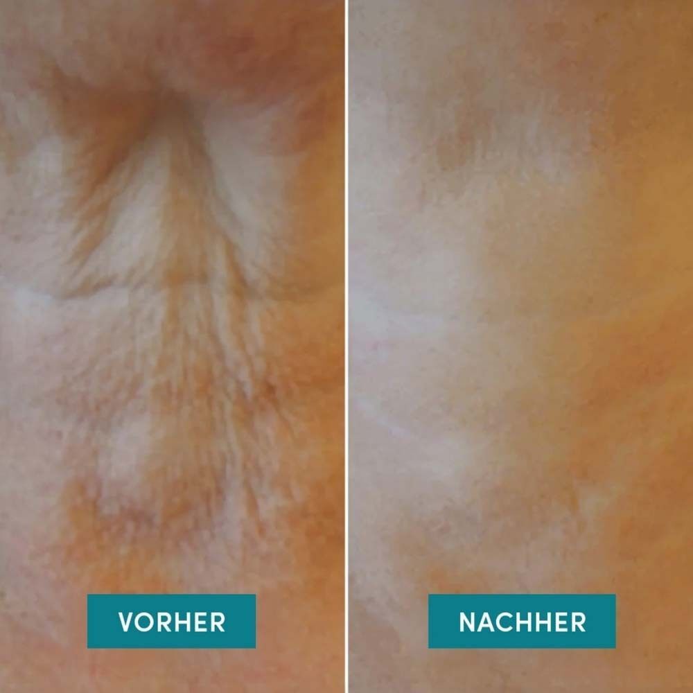 Zwei Nahaufnahmen von Hautpartien. Links: Vorher. Rechts: Nachher. Blaue Textfelder mit den Beschriftungen.