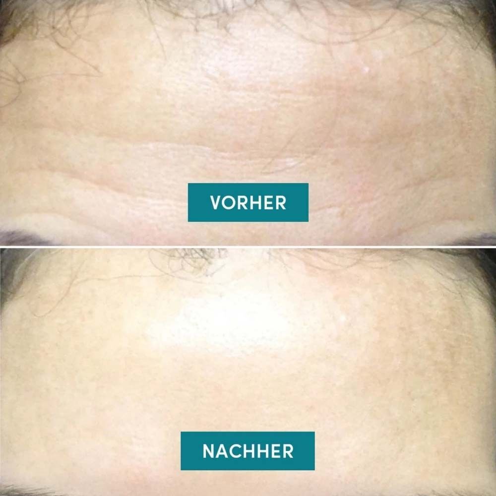 Zwei Bilder zeigen die Stirn vor und nach der Anwendung. 'Vorher' zeigt Falten, 'Nachher' zeigt glattere Haut.