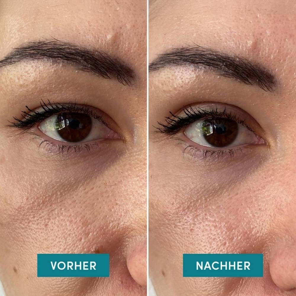 Vergleichsbild: Augenpartie vor und nach der Anwendung. Links: Vorher. Rechts: Nachher. Deutliche Veränderung.