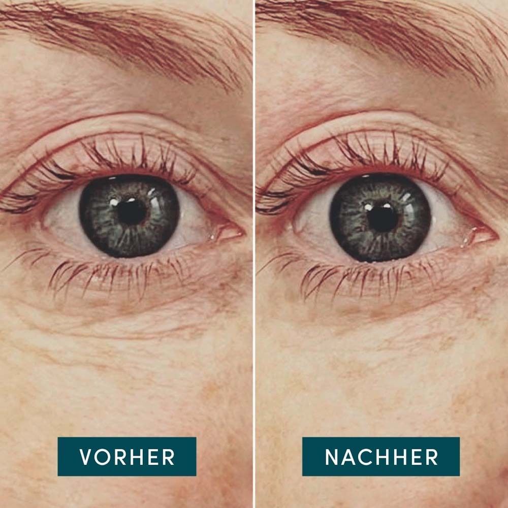 Zwei Nahaufnahmen von Augen. Links: Vorher. Rechts: Nachher. Text: Vorher, Nachher.
