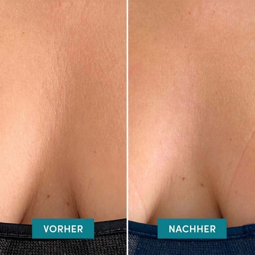 Vorher-Nachher-Vergleich. Dekolleté mit Falten (vorher) und glatter Haut (nachher).