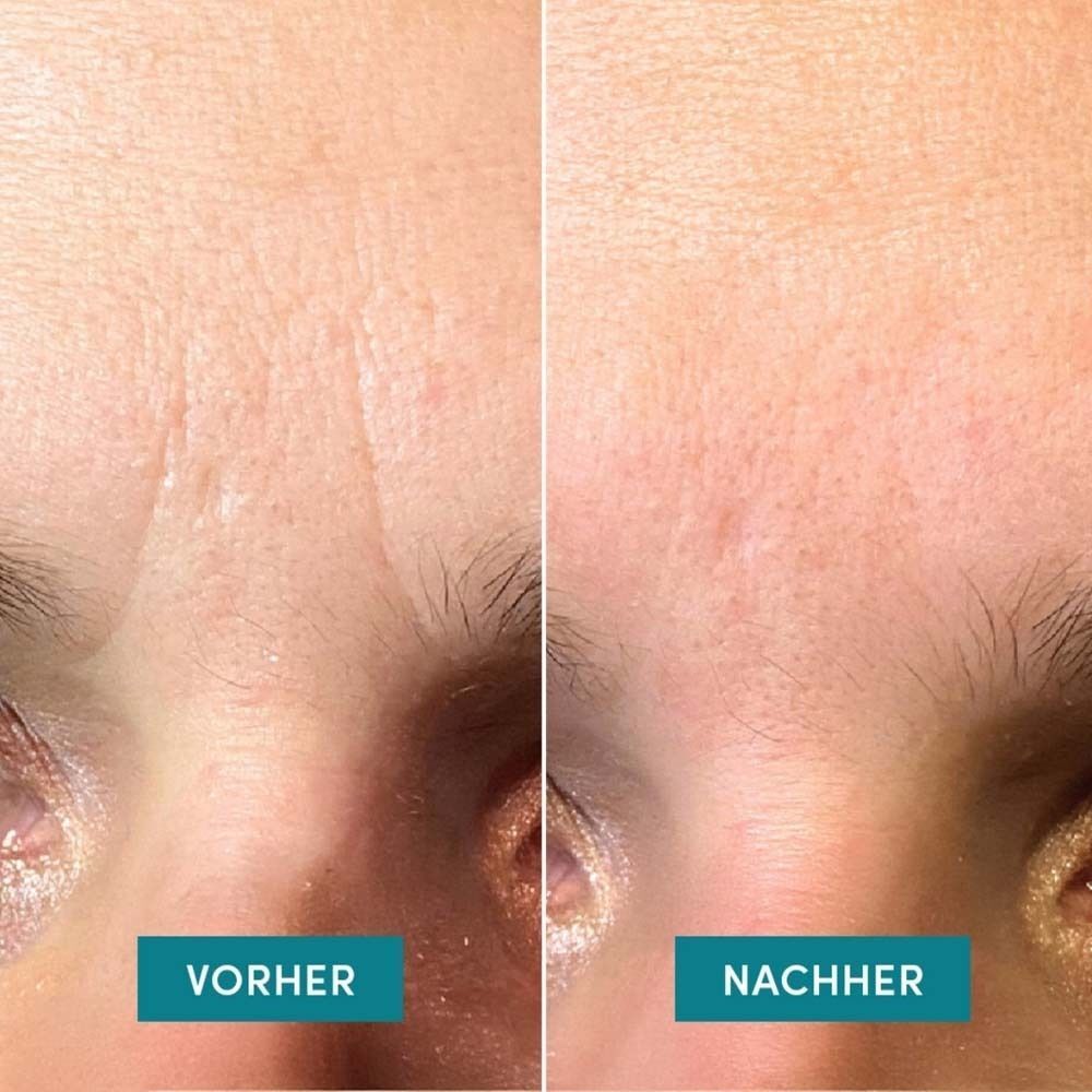 Vorher-Nachher-Vergleich. Links: gerunzelte Stirn. Rechts: glatte Stirn. Blaue Balken mit 'VORHER' und 'NACHHER'.