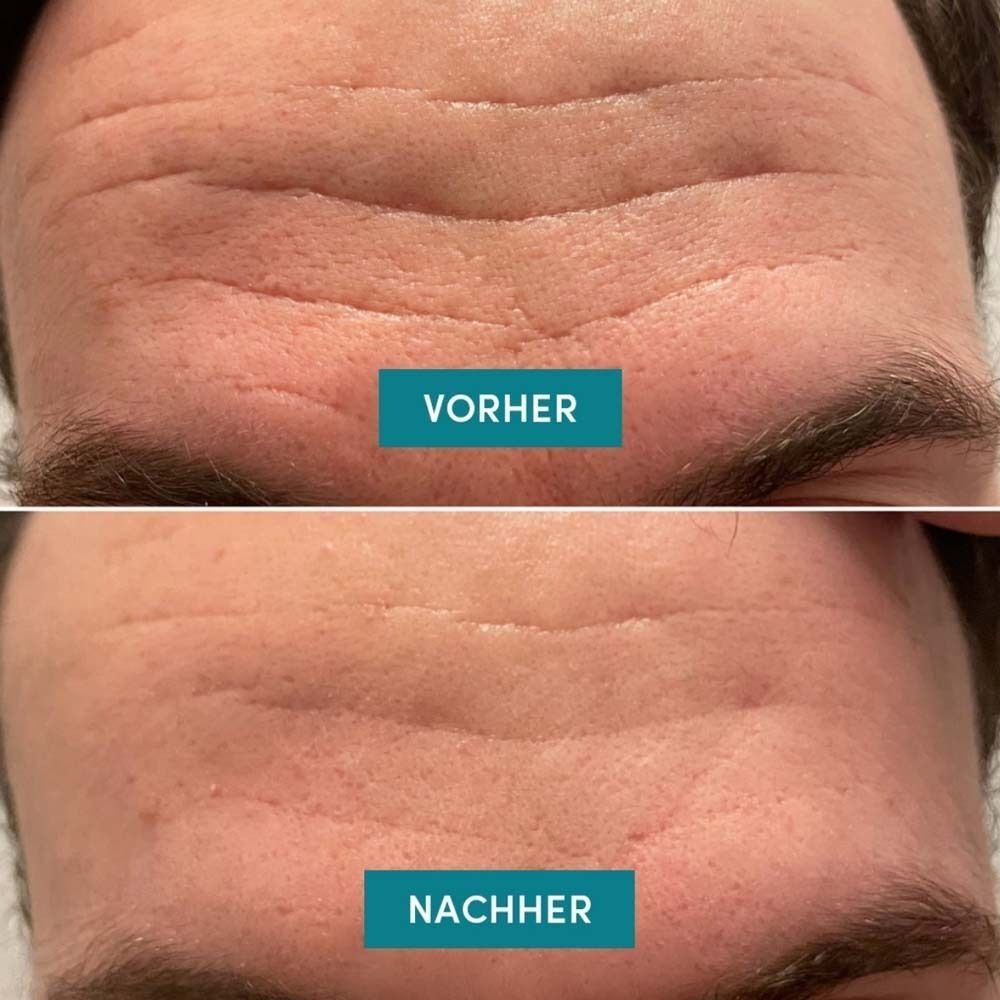 Vorher-Nachher-Vergleich. Stirn mit Falten. Beschriftung: Vorher, Nachher.