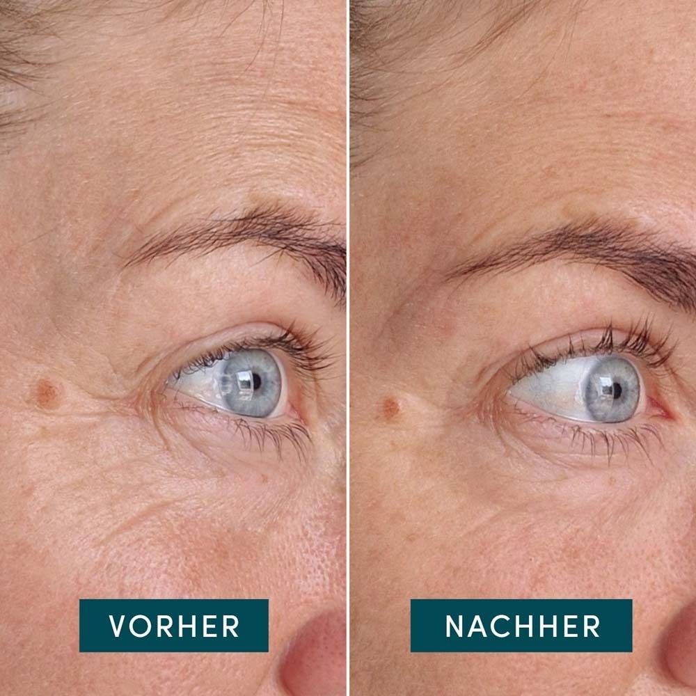 Vergleichsbild: Vorher-Nachher. Links: Gesicht mit Falten. Rechts: Gesicht mit weniger Falten. Text: Vorher, Nachher.