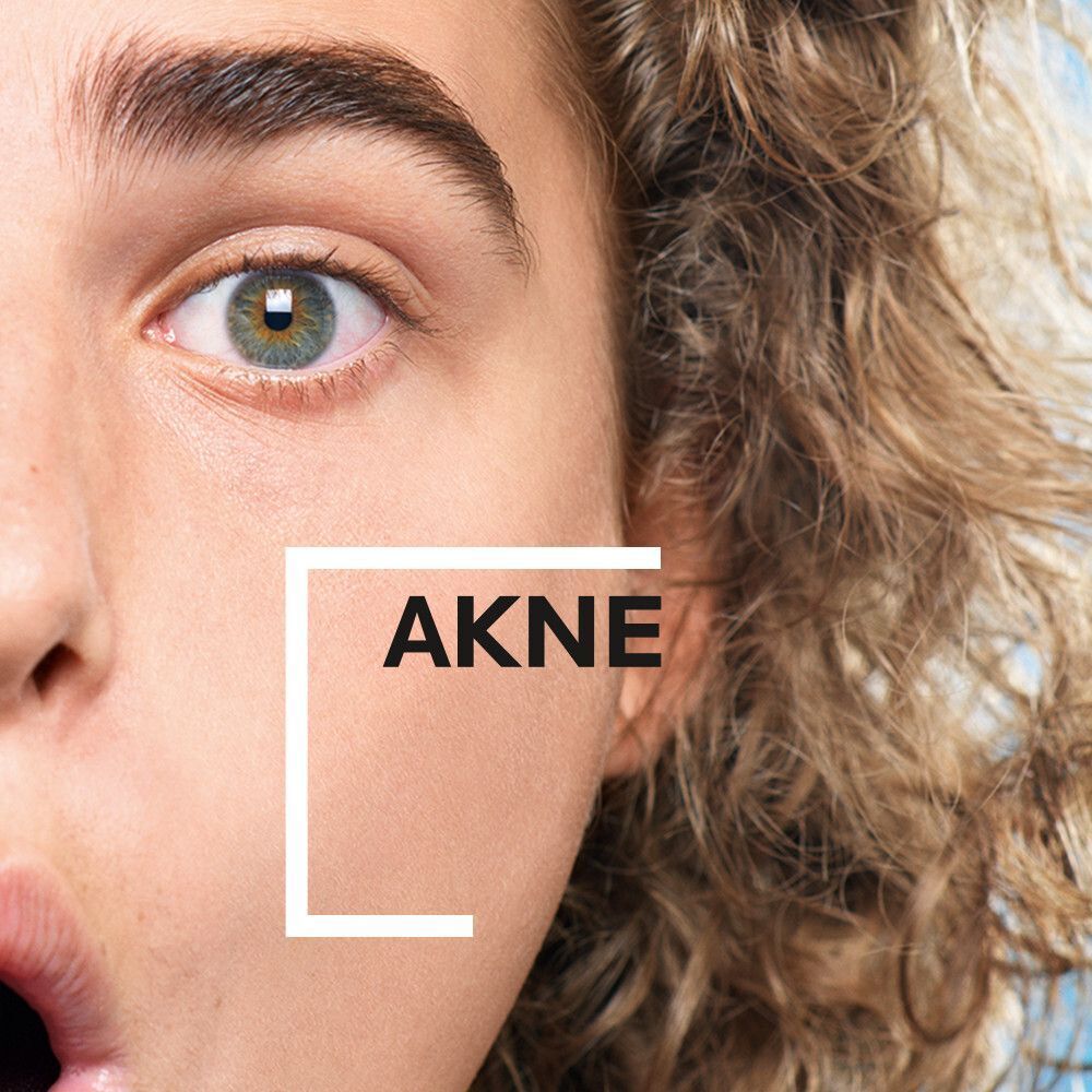 Nahaufnahme eines Gesichts mit dem Wort 'AKNE' im Fokus. Zeigt die Zielgruppe des Produkts.