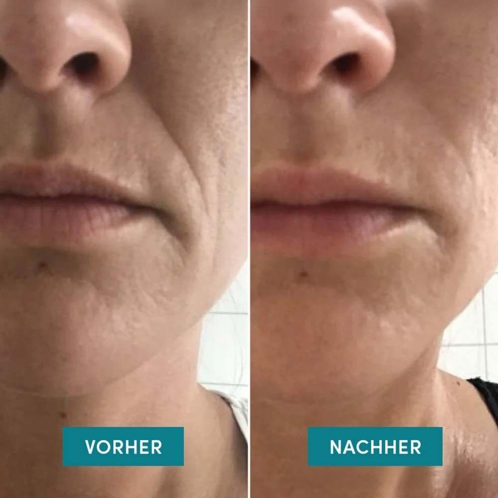 Vorher-Nachher-Vergleich der Haut um den Mundbereich mit Falten.