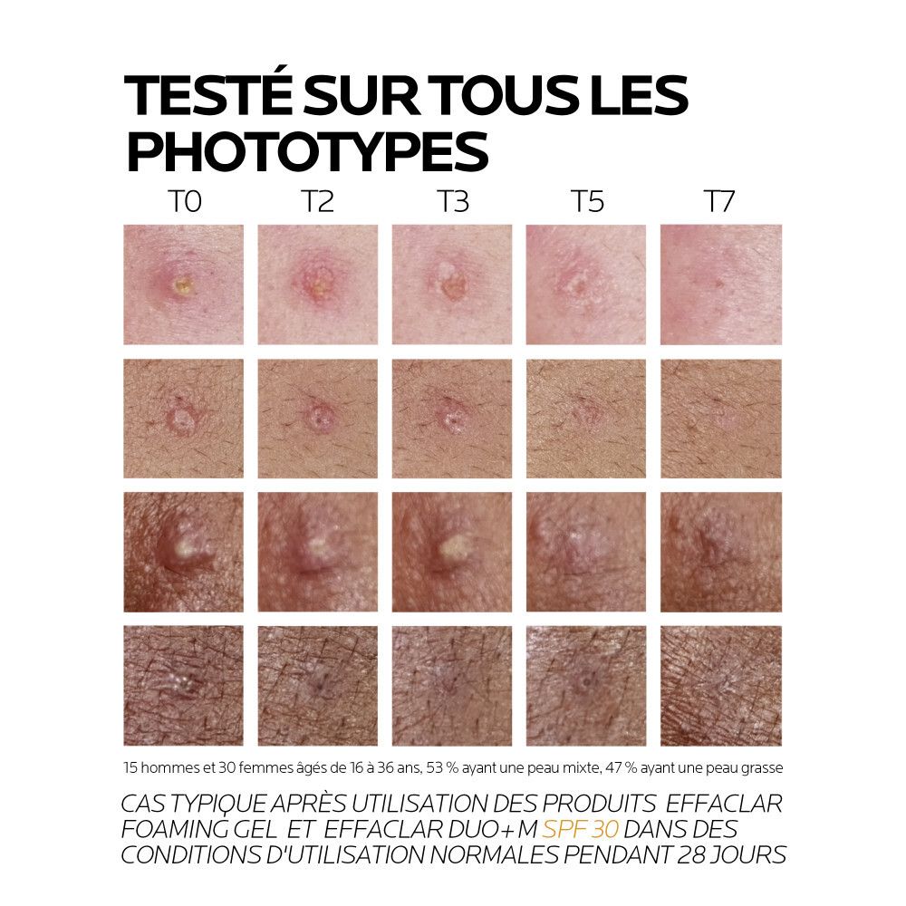 Vergleichsbilder von Hauttypen vor und nach der Anwendung von La Roche Posay Effaclar Duo+ M LSF 30.