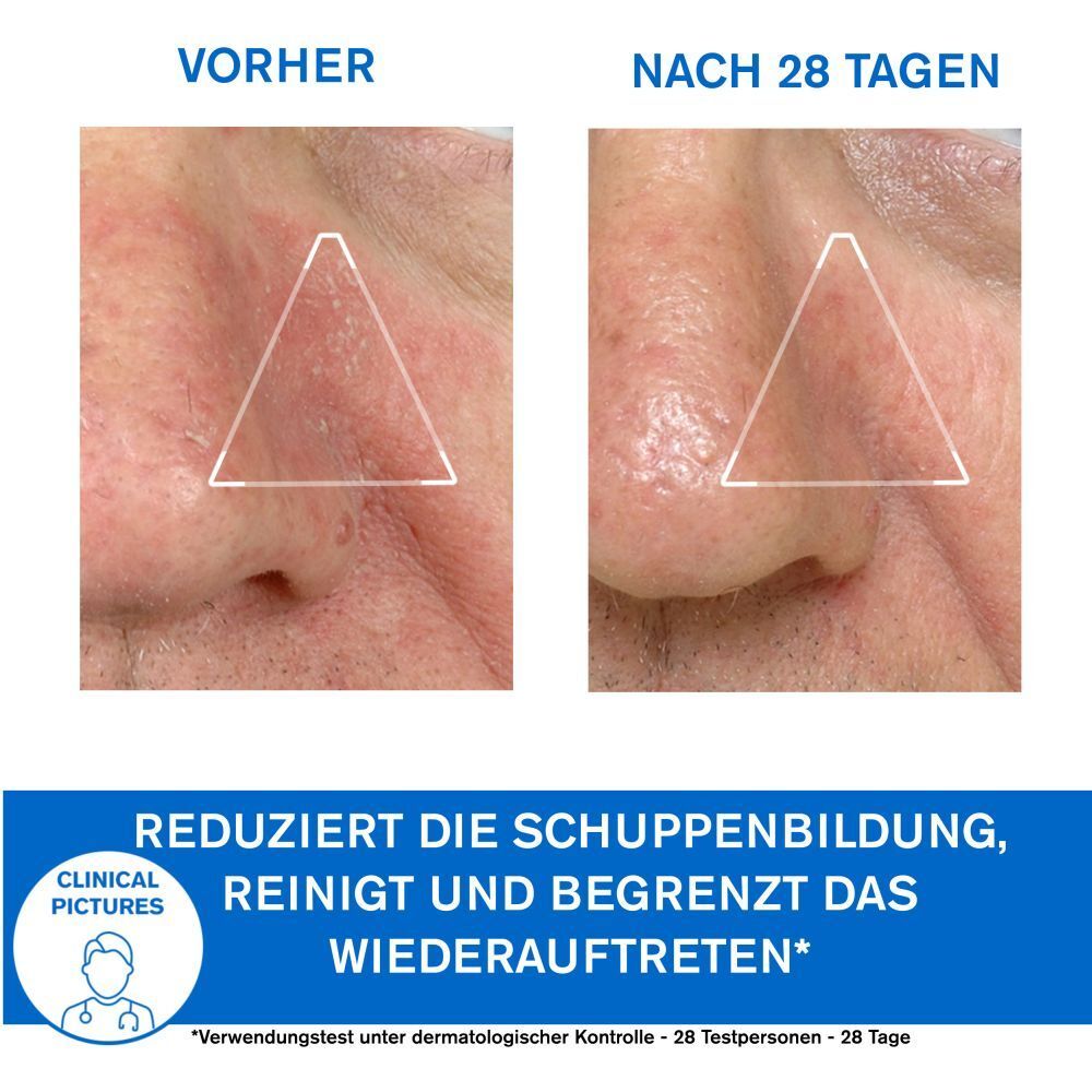 Vorher-Nachher-Vergleich. Nase mit Schuppenbildung. Text: Reduziert die Schuppenbildung, reinigt und begrenzt das Wiederauftreten.