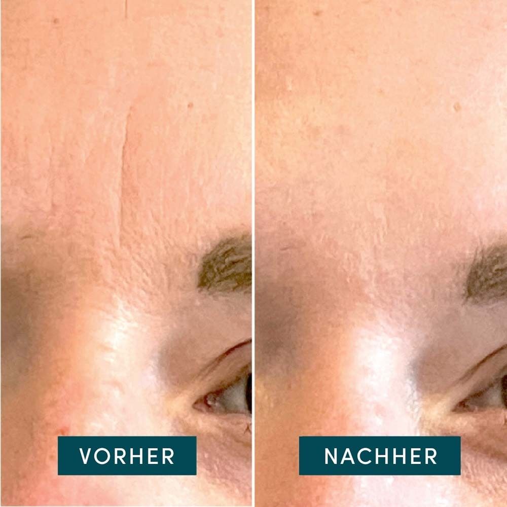 Vorher-Nachher-Vergleich von Haut. Beschriftung: Vorher, Nachher.