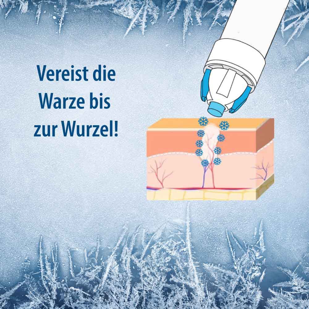 Evolsin® Warzenvereiser – Entfernung von Warzen und Dornwarzen sicher & effektiv