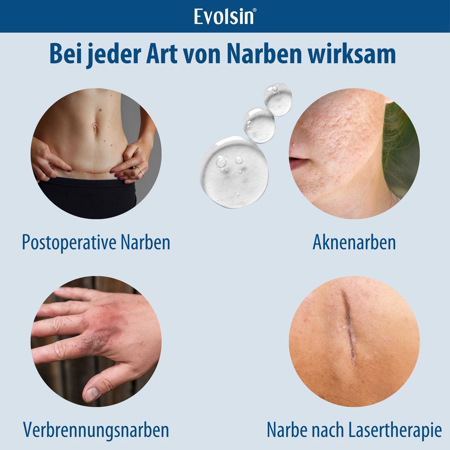 Evolsin® Narbengel für Kinder & Erwachsene – Narbensalbe reduziert die Sichtbarkeit von Narben – Narbencreme für Narben aller Art