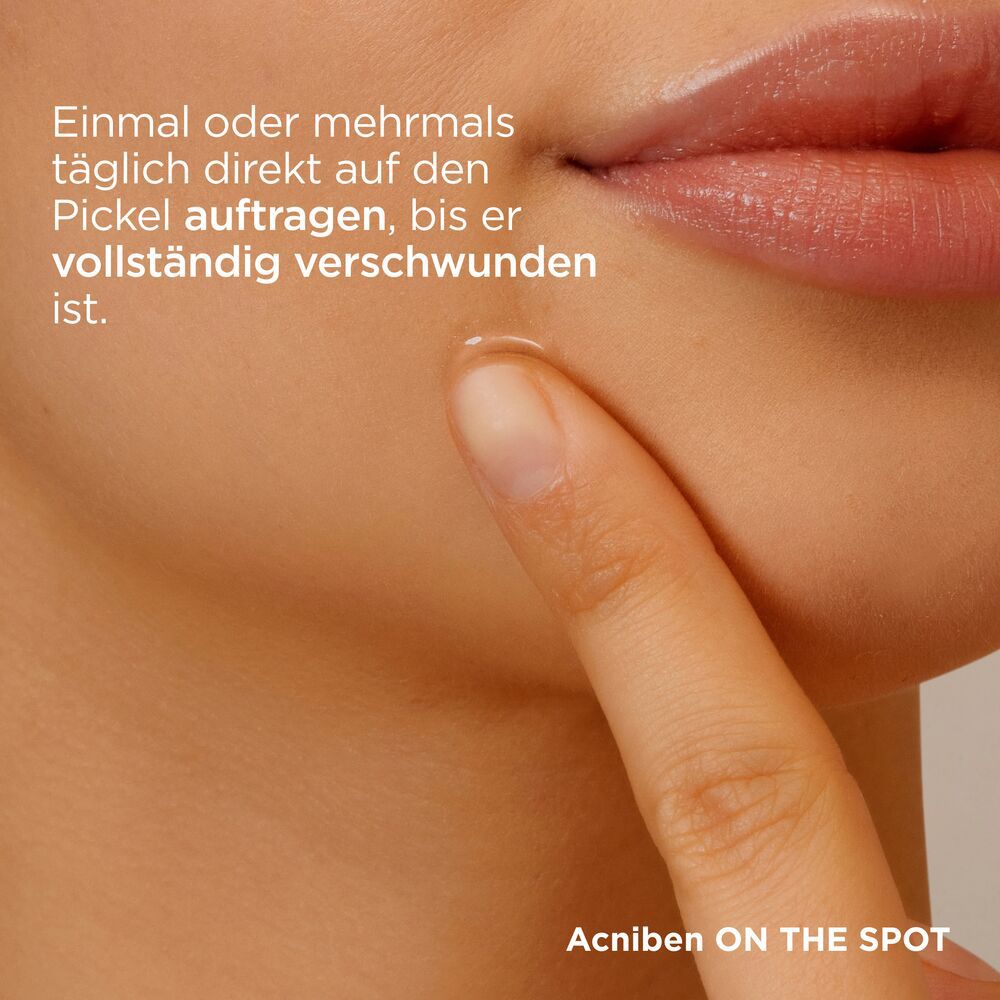 Hand mit Finger, der Gel auf Pickel aufträgt. Text: Einmal oder mehrmals täglich direkt auf den Pickel auftragen.