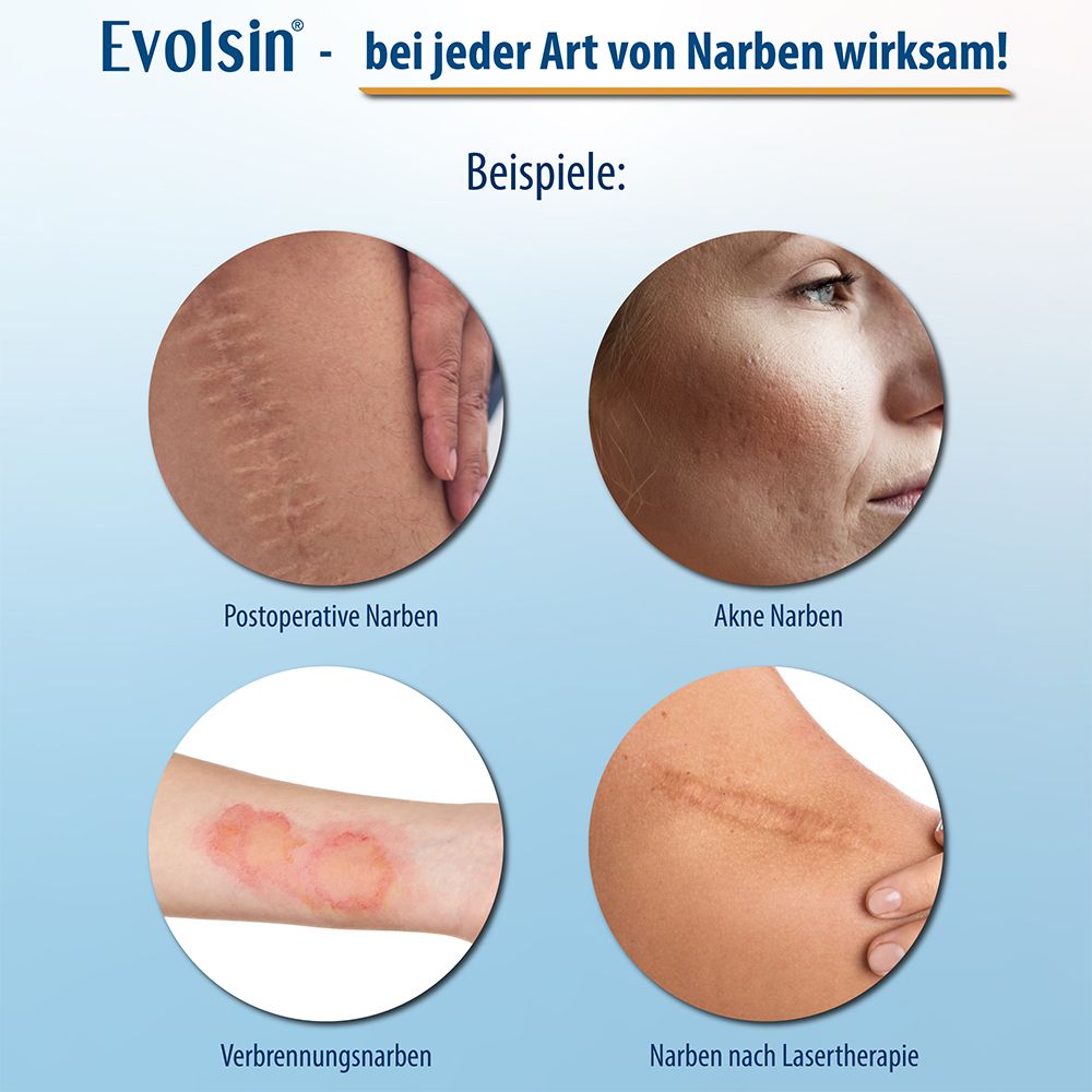 Evolsin® Transparentes Narbenpflaster – für Narben aller Art – Narbenpflaster aus Silikon reduziert sichtbar Narben - für eine einfache Behandlung (200 cm)