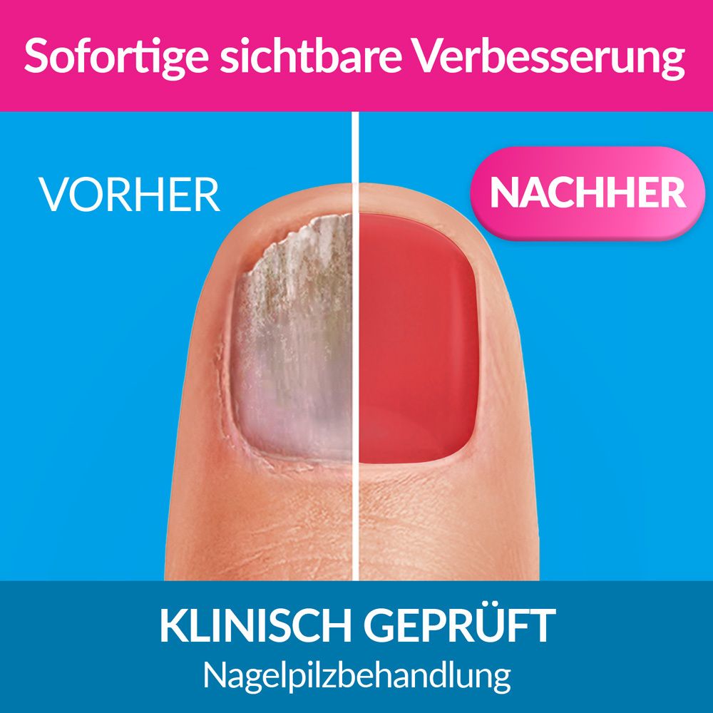 Nagel mit Nagelpilz. Vorher-Nachher-Vergleich. Nagel ist rot nach Behandlung. Klinisch geprüft.