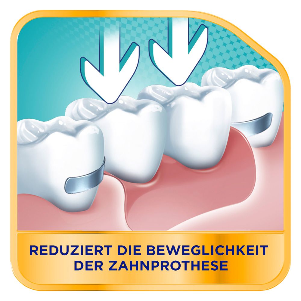 Zähne mit Zahnprothesen, Pfeile zeigen auf die Zähne. Text: Reduziert die Beweglichkeit der Zahnprothese.