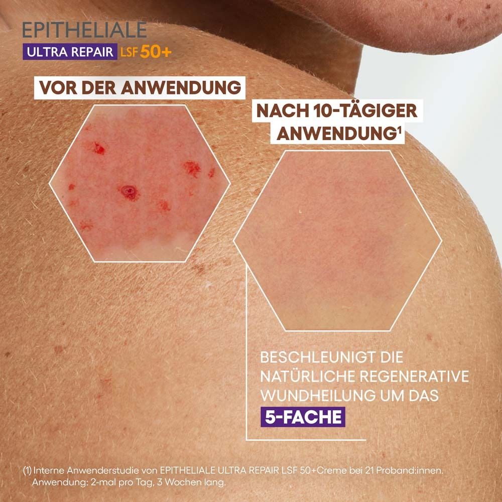 Haut mit roten Stellen vor und nach 10-tägiger Anwendung. Text: Beschleunigt die natürliche regenerative Wundheilung um das 5-fache.