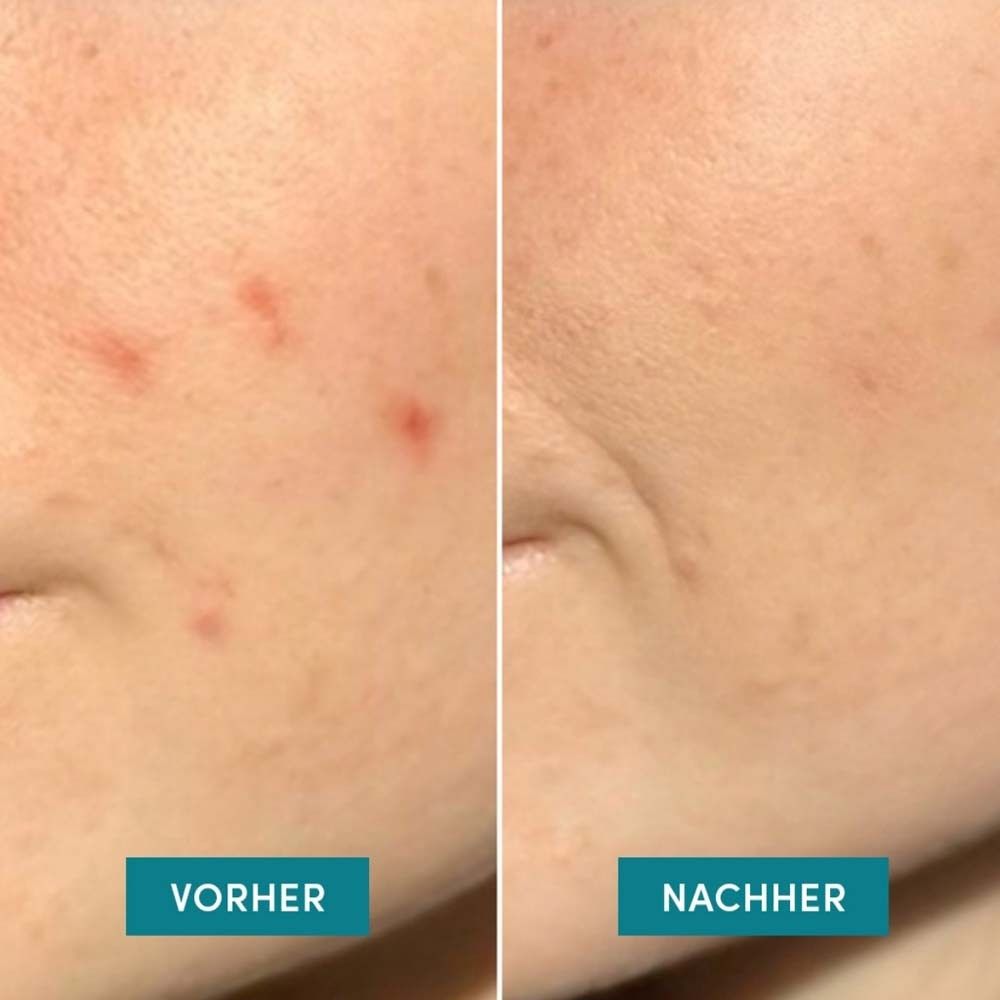 Vorher-Nachher-Vergleich. Haut mit Pickeln vs. Haut nach der Anwendung von Pickel Patches.