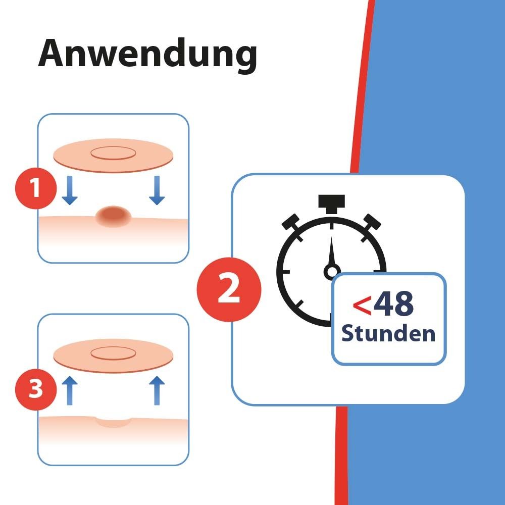 Anwendungsschritte: 1. Pflaster auf Warze. 2. <48 Stunden. 3. Pflaster entfernen.
