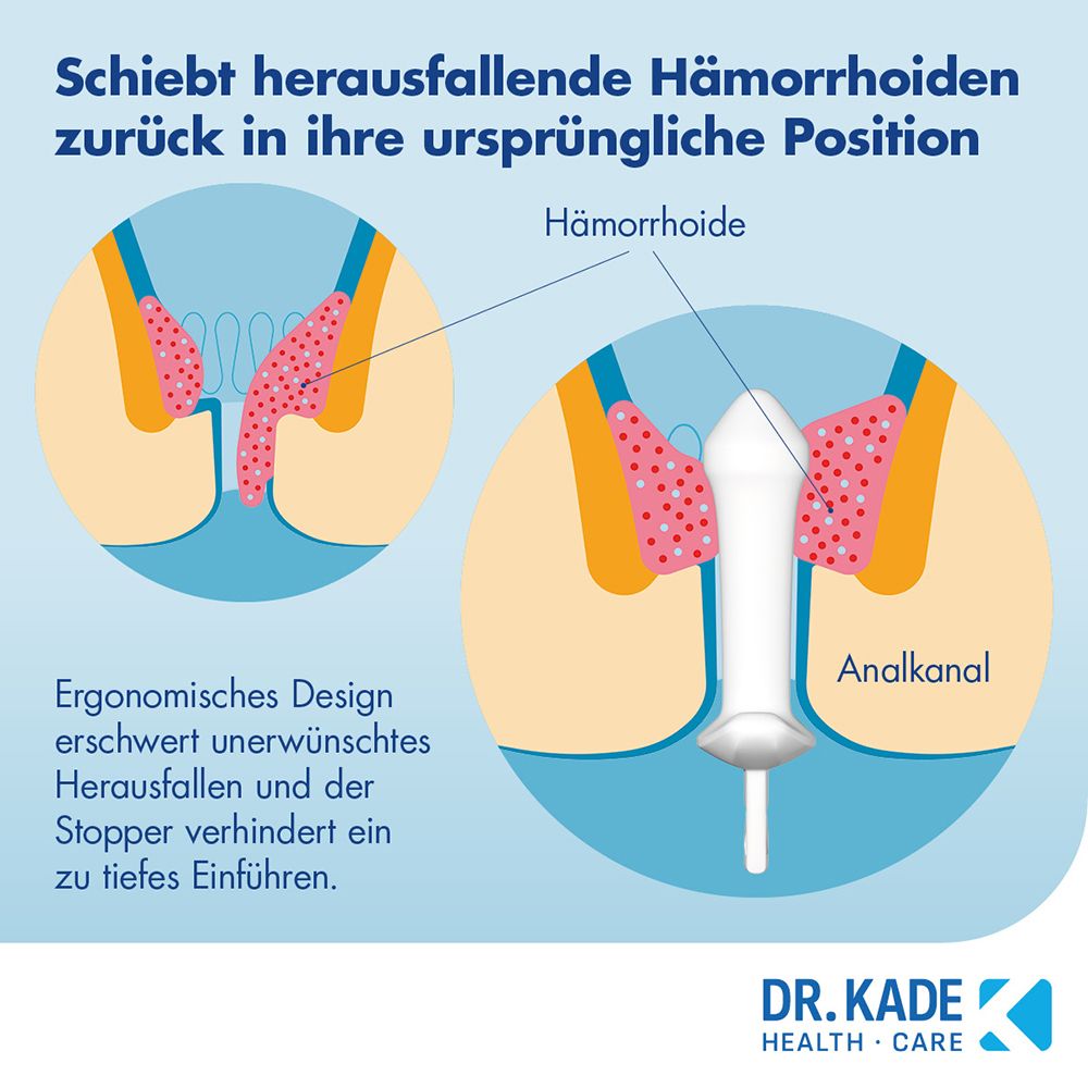 Illustration: Hämorrhoiden-Stick schiebt Hämorrhoide zurück in den Analkanal. Ergonomisches Design.