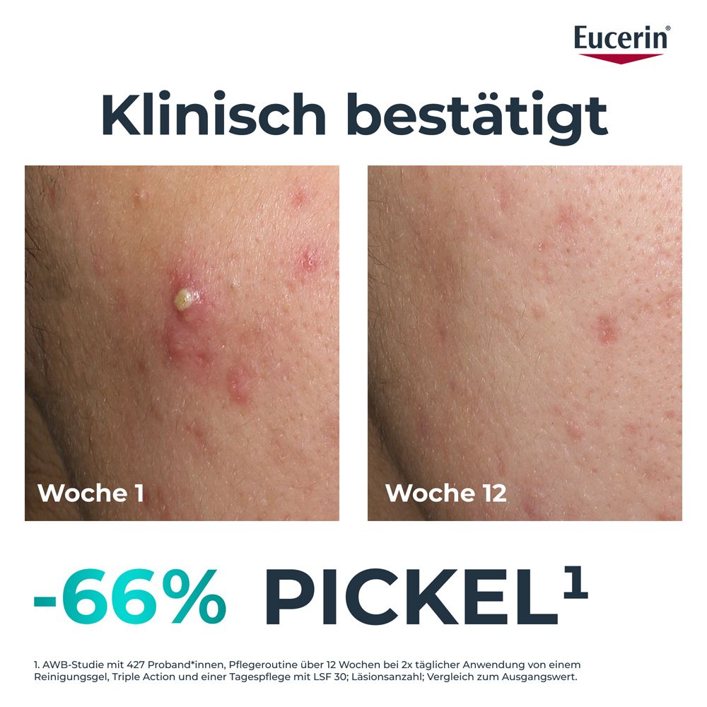 Vorher-Nachher-Bild. Haut mit Pickeln (Woche 0) und verbesserte Haut (Woche 12). Text: -66% Pickel.