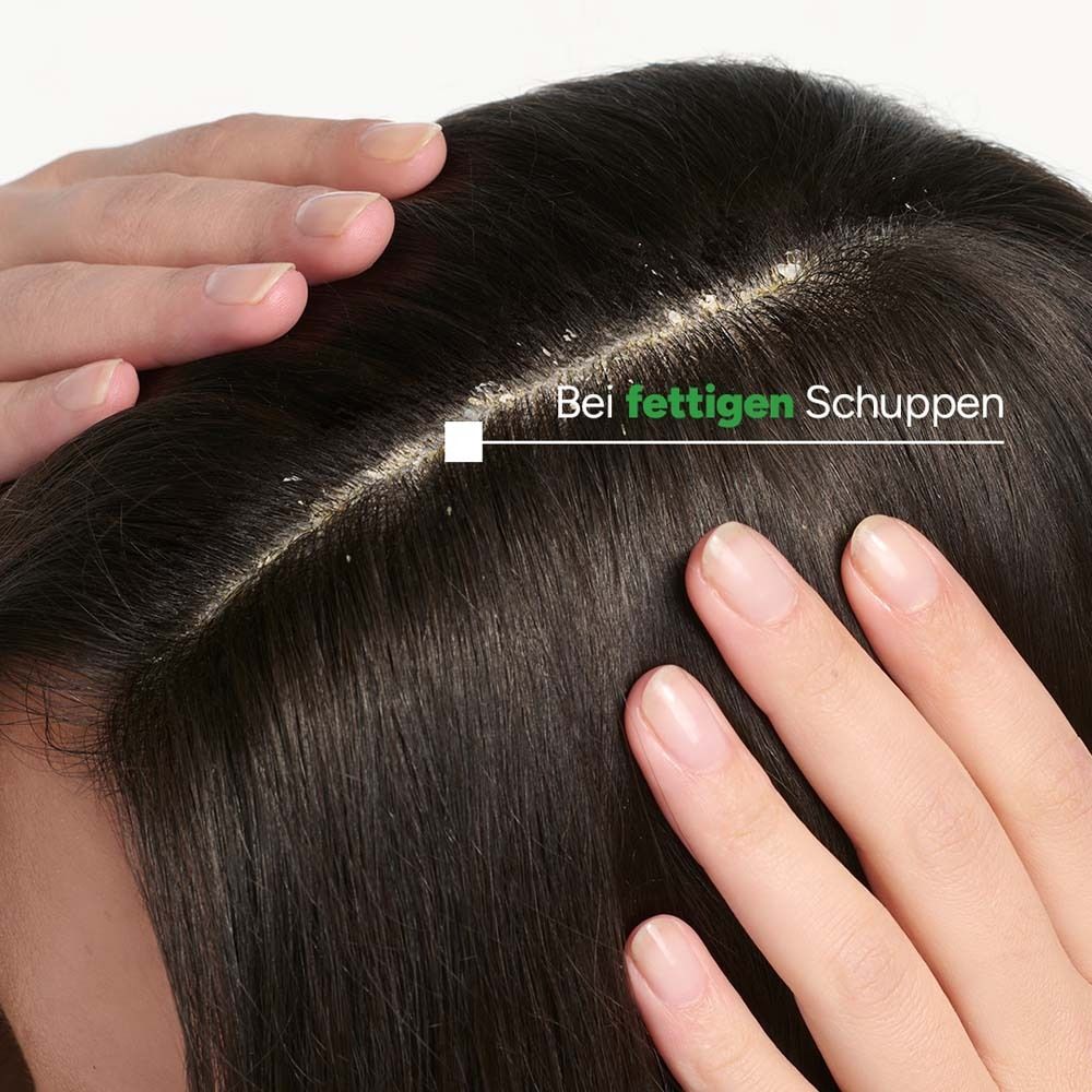 Kopfhaut mit fettigen Schuppen. Hände berühren die Kopfhaut. Text: Bei fettigen Schuppen.