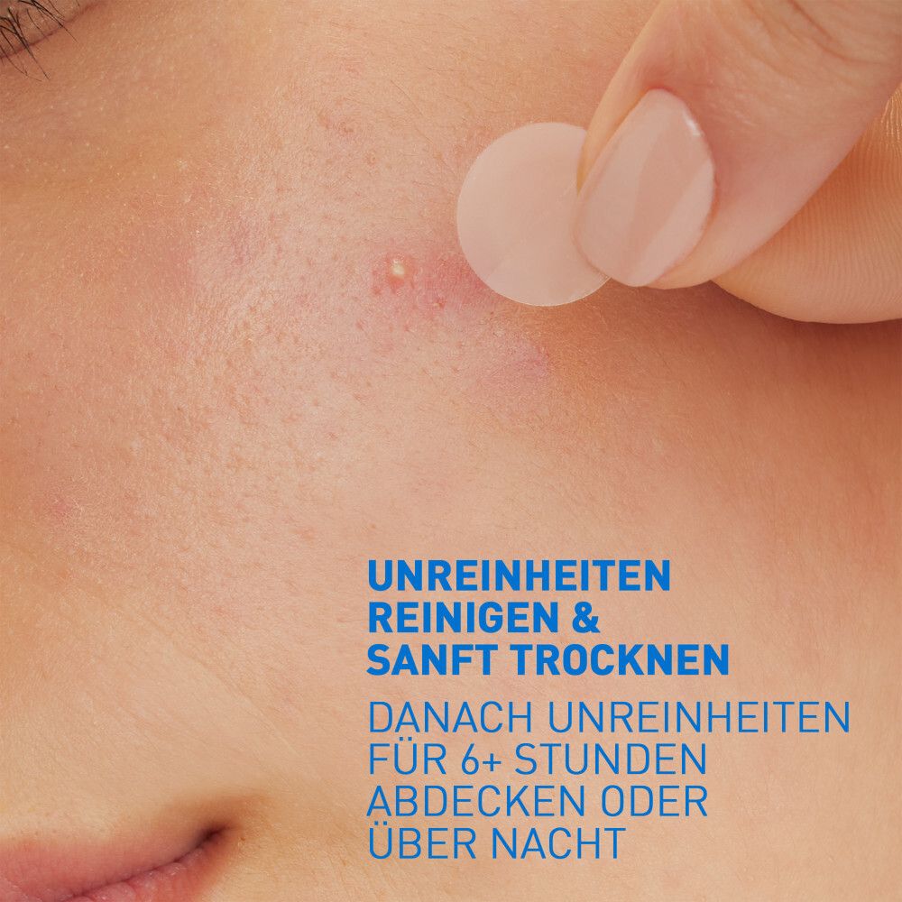 Ein Patch wird auf einen Pickel aufgetragen. Unreinheiten reinigen & sanft trocknen. Abdecken für 6+ Stunden.