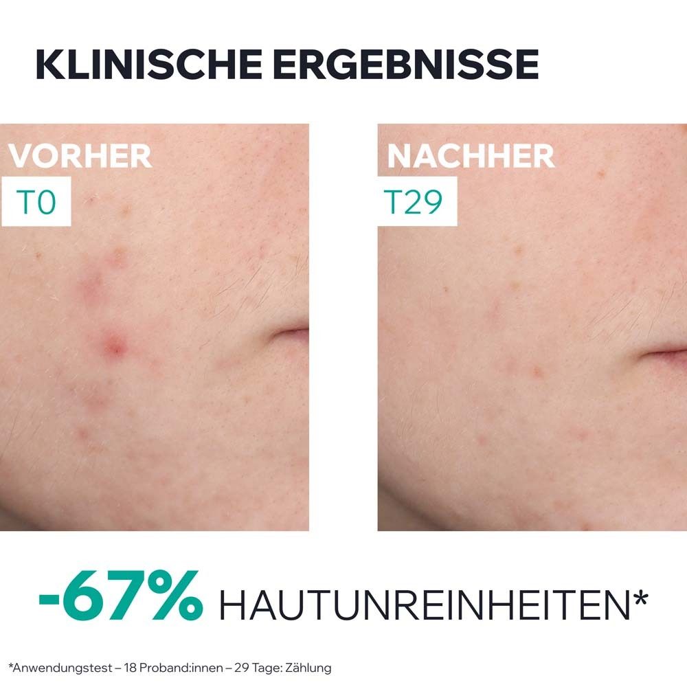 Vorher-Nachher-Vergleich. Text: -67% Hautunreinheiten. Vorher: Haut mit Pickeln. Nachher: Verbesserte Haut.