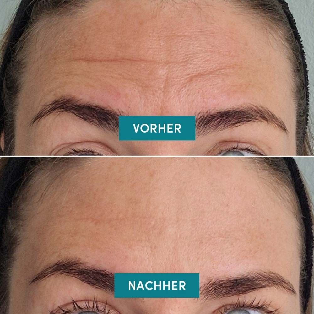 Vorher-Nachher-Vergleich. Zwei Fotos von Stirnfalten. Oben: Vorher. Unten: Nachher. Text in Türkis.