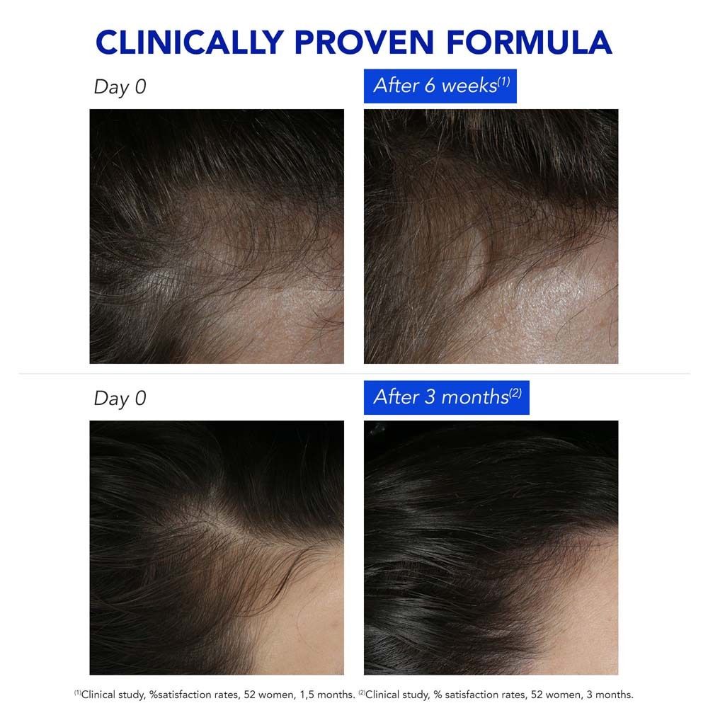 Vergleichsbilder von Kopfhaut und Haaren. Vorher/Nachher-Darstellung. Text: Klinisch nachgewiesene Formel. Ergebnisse nach 6 Wochen und 3 Monaten.