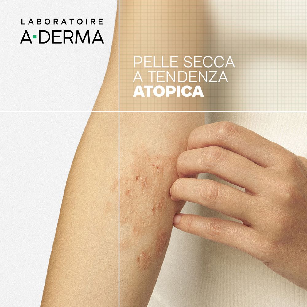 Arm mit atopischer Haut, die von einer Hand gekratzt wird. A-Derma Logo oben links.