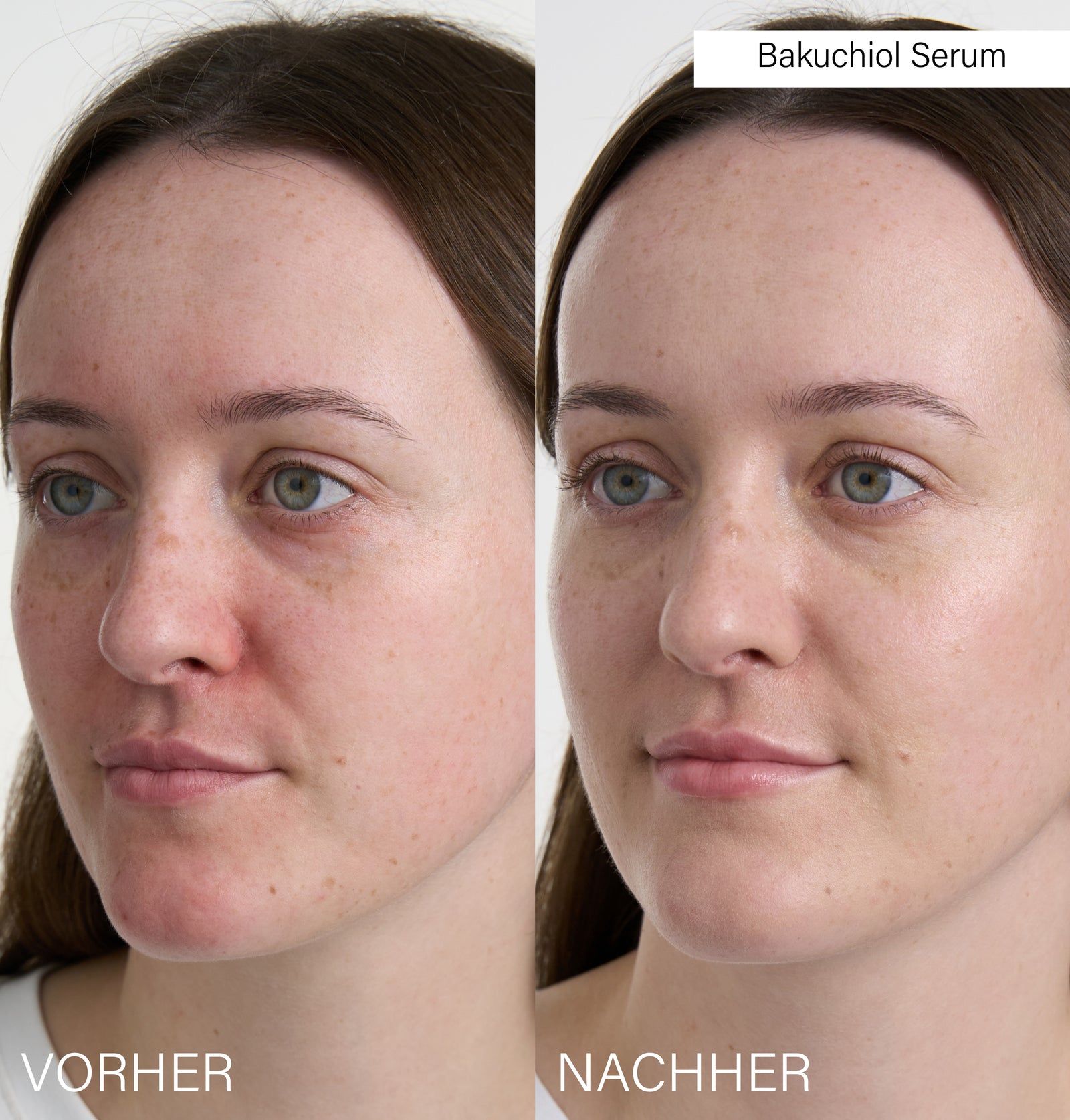 Vorher-Nachher-Vergleich. Gesicht einer Frau. Links: gerötete Haut. Rechts: ebenmäßiger Teint. Bakuchiol Serum.