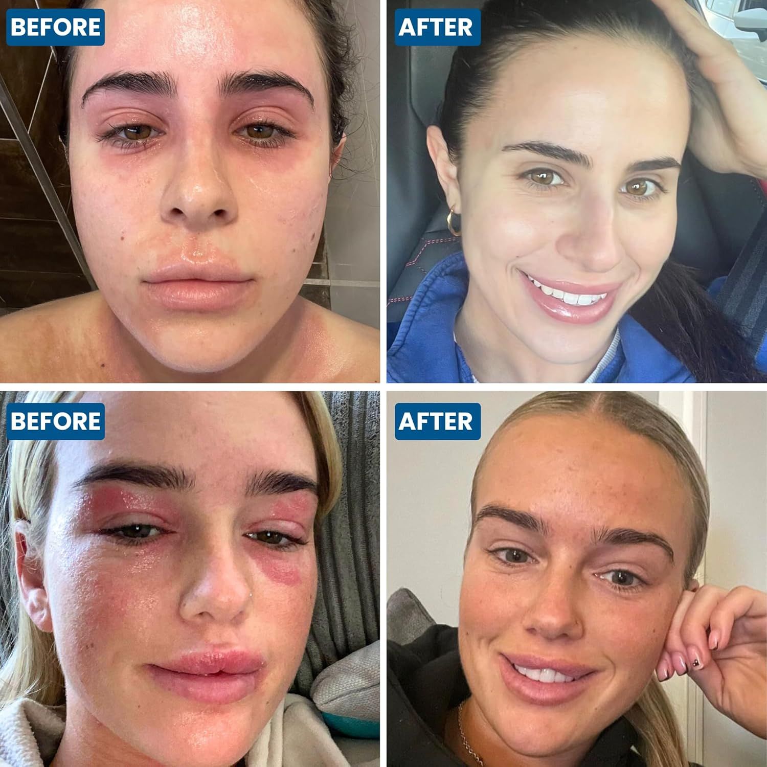 Vorher-Nachher-Vergleich von zwei Frauen. Gesichtsrötungen und Schwellungen vor der Behandlung, Verbesserung danach.