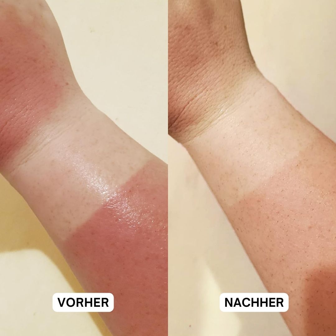 Zwei Arme. Links: sonnenverbrannte Haut. Rechts: Haut nach Anwendung. Text: Vorher, Nachher.