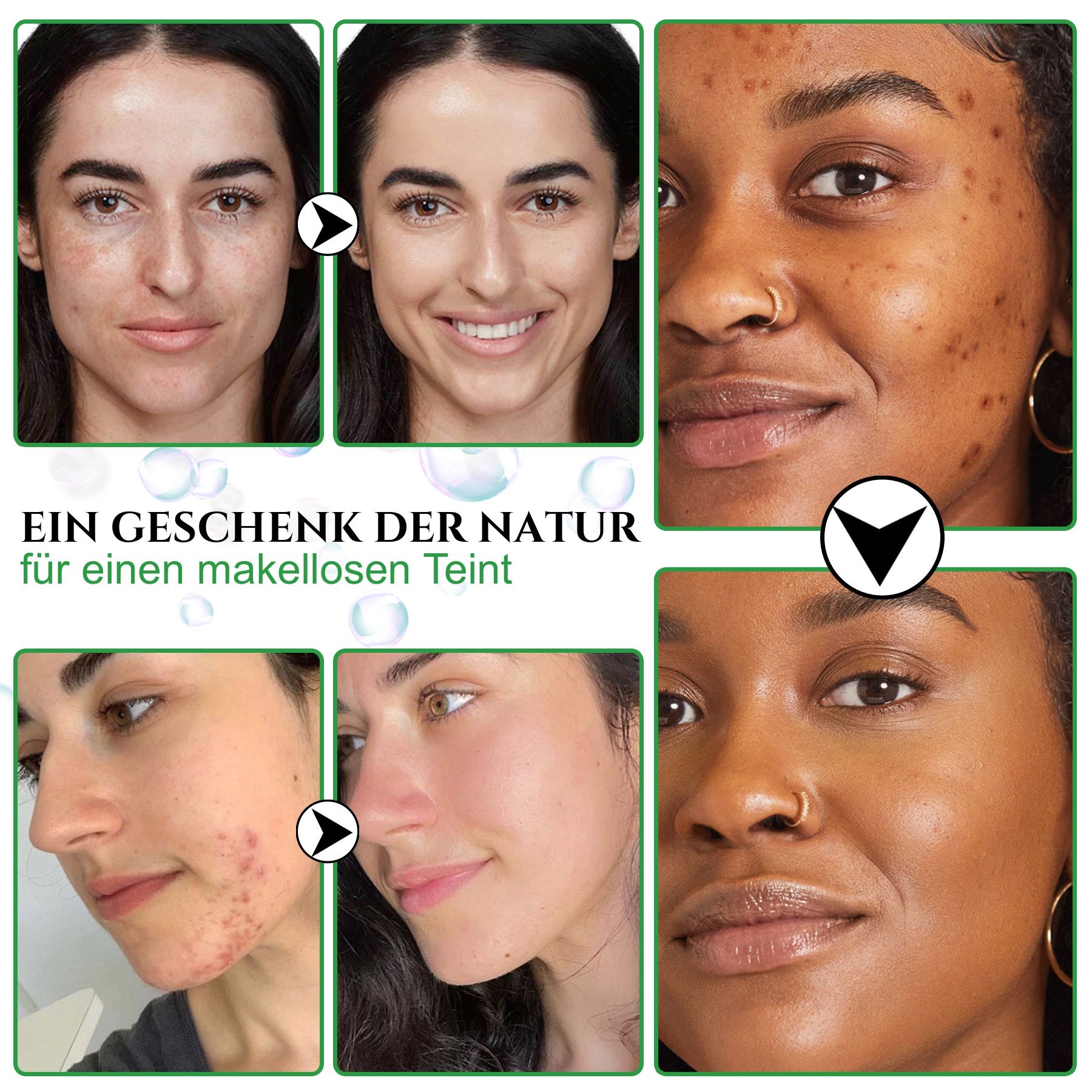 Vorher-Nachher-Bilder von Gesichtern. Text: Ein Geschenk der Natur für einen makellosen Teint. Reduziert Akne und Hautunreinheiten.