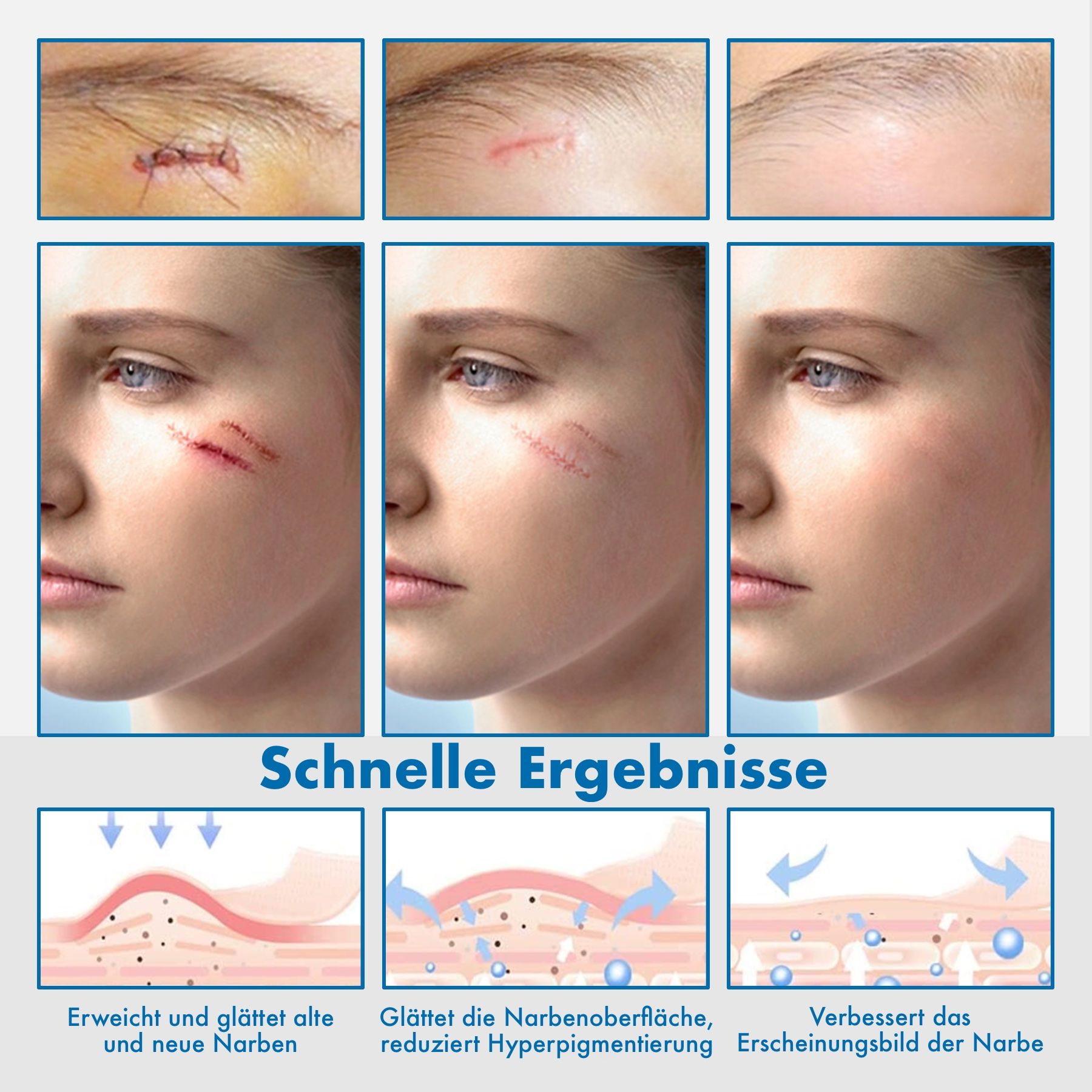 Vorher-Nachher-Bilder von Narben. Text: Schnelle Ergebnisse. ELAIMEI Clear Silicone Scar Sheets. Diagramme der Hautschichten.