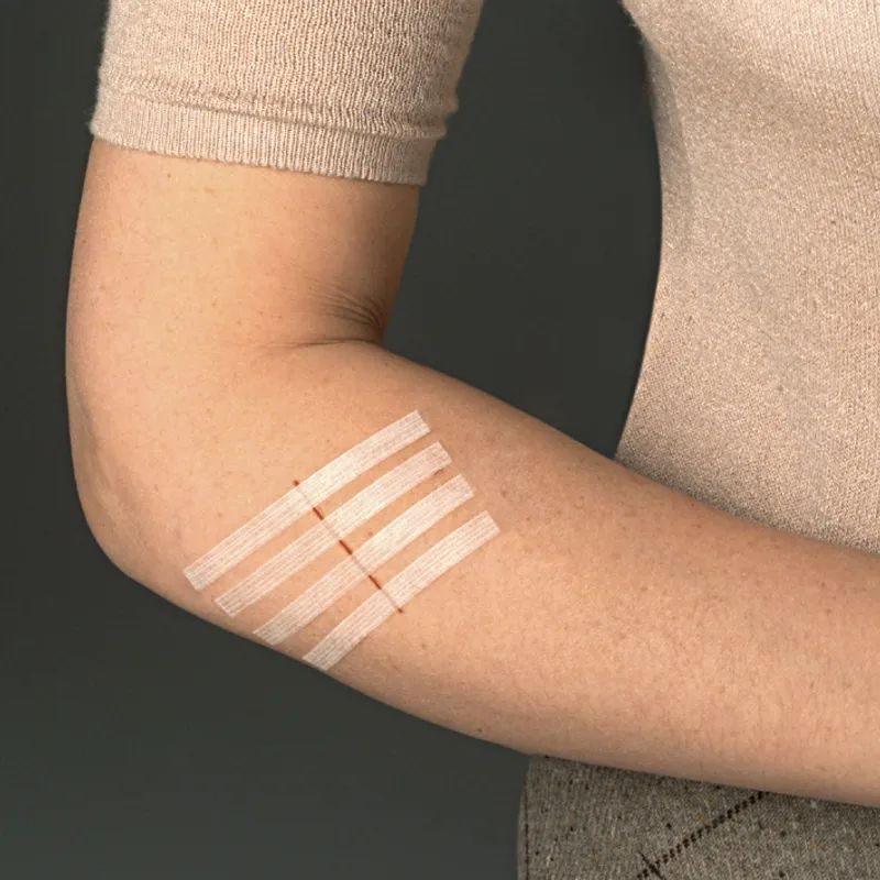 Arm mit Streifen. Auf der Haut sind mehrere weiße Streifen mit roten Linien zu sehen.