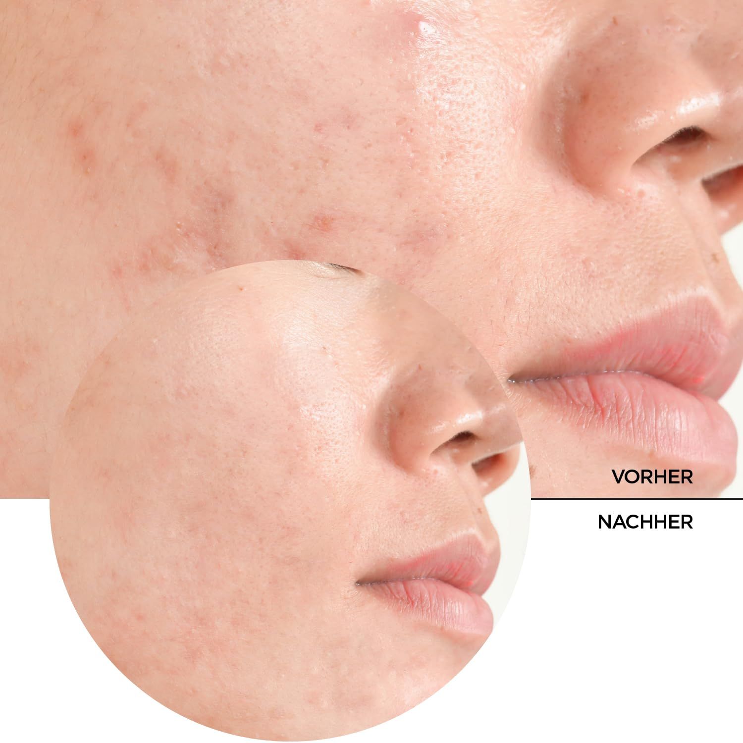 Revox Just Salicylic Acid 2% Peeling Solution: Vorher-Nachher-Hautbild.